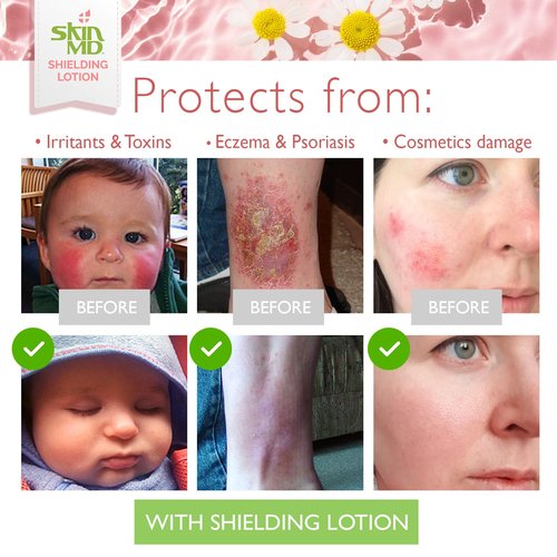 Skin MD Shielding Lotion for Face, Body & Hands 8oz with Dispenser- Helps with Eczema & Psoriasis! The natural dry skin remedy to the things that dry your skin