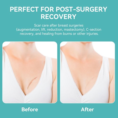 Silicone Scar Sheets for Breast – 6 Anchor Shape Patches | Medical Grade Silicone, Hypoallergenic & Reusable for Breast Lift, Reduction, Augmentation or Mastectomy Surgery Scar Removal