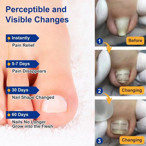 Nitinol Ingrown Toenail Corrector,at Home Ingrown Toenail Treatment,Curved Toenail Straightener,Ingrown Toe Nail Relief，Ingrown Toenail Removal Kit (1/2 In,11/16 In)