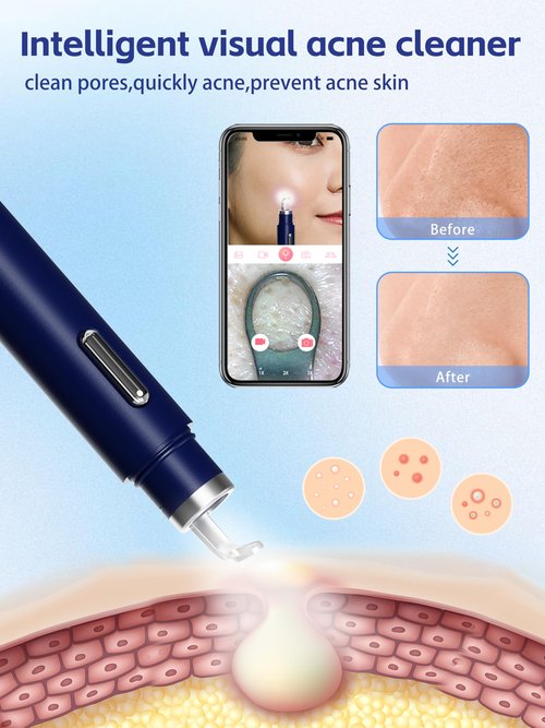 Visual Blackhead Remover Tools with Camera,Pimple Popper Extractor Tool Kit with Camera 20X 1080P Pore Cleaner Acne Comedone Whitehead Extractor Kit for iPhone/Android (Blue)