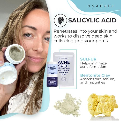 Ayadara Day & Night Cystic Acne Spot Care for Skin, Hormonal Acne Support for Daytime & Overnight, Cystic Acne Skin Balancing Formula for Face, Acne Cream with Tea Tree & Bentonite Clay, 90 Day Supply