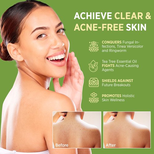 Roycederm Tea Tree Antifungal Care Set - Scalp & Skin Solution Bundle