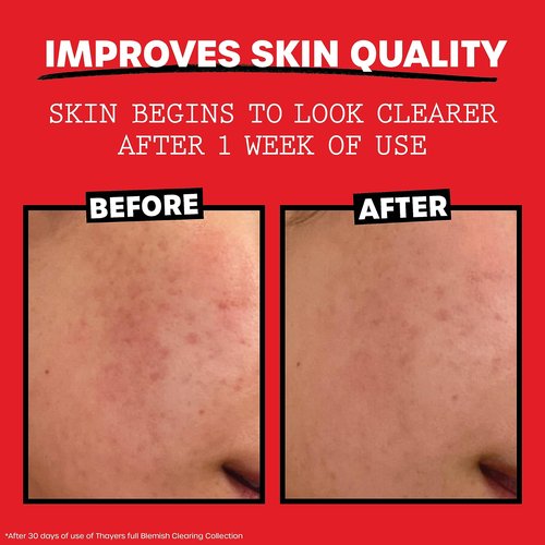 THAYERS Witch Hazel Blemish Cleanser, 4 Ounce
