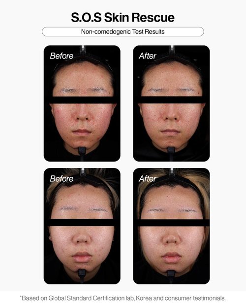 NURICLE BETELCHLOROUS S.O.S Rescue Dose 30ml(1.014 fl.oz) – Hypochlorous Acid Face Serum for Acne, Redness & Sensitive Skin – Korean Skin care Calming Serum