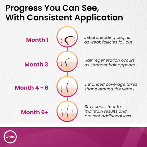 Minoxidil for Women 5% Foam - Helps Restore Top of Scalp Hair Loss and Support Hair Growth for Women, Regrowth with Unscented Topical Treatment for Thinning Hair (5% Foam 4-Month Supply)