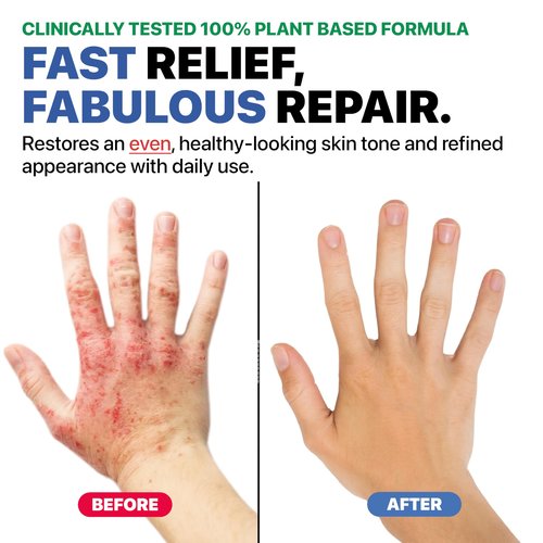 Dr. Arsy Eczema Cream for Adults & Kids – Hypoallergenic Barrier Repair Moisturizer, Clinically Proven (3 Studies), Fragrance-Free, Dermatologist Tested, Face & Body Hydration, NEA Accepted, USA Made