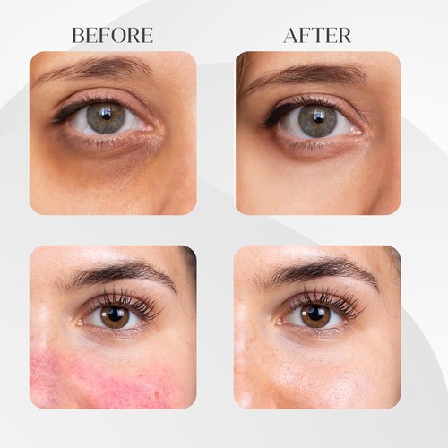 FEEL MATRIGEN Vitamin K 100 Ampoule – Redness & Dark Circle Treatment Serum for Sensitive Skin – 30mL + Needleless Syringe