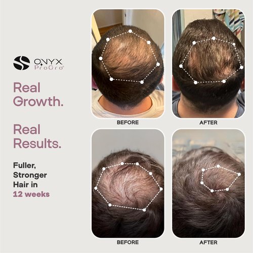 ONYX ProGro LactoPherma Hair Growth Serum for Women & Men – Oil-Free Formula with 12 Active Ingredients – Boosts Regrowth, Thickens Hair, Reduces Hair Shedding & Thinning, Stimulates Scalp Circulation