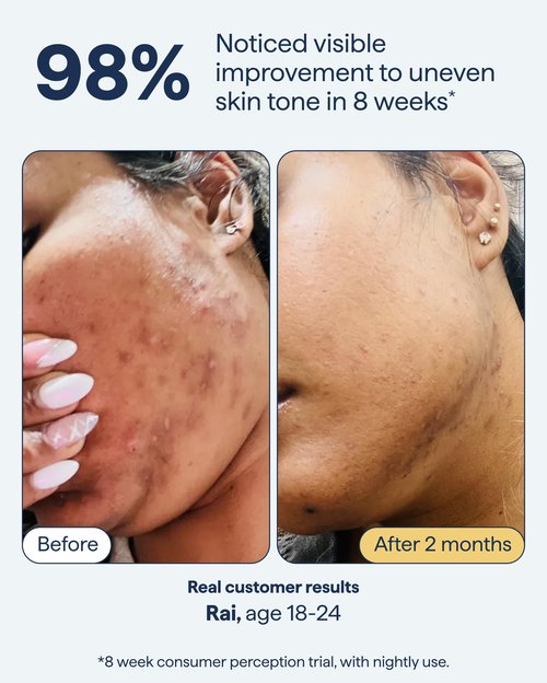 Remedy for Dark Spots – Discoloration Treatment For Face with Retinol, Glutathione, Niacinamide, Mandelic Acid, Kojic Acid and Tranexamic Acid – By Dermatologist Dr. Shah