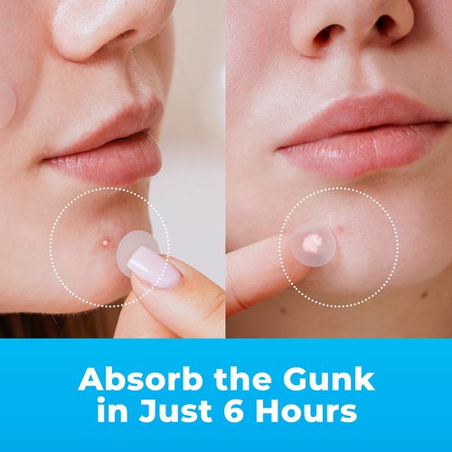 PatchRx Pimple Patches for Face (500 Patches), Hydrocolloid Acne Patches with Tea Tree Oil, Pimple Patch Pimple Stickers - Hydrocolloid Patch Acne Dots - Acne Pimple Patches For Face - Zit Patches