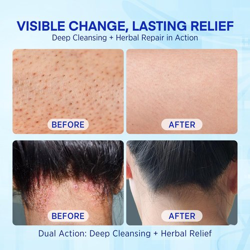 Hermon Folliculitis Treatment Kit – Shampoo & Cream Combo for Scalp, Body & Intimate Areas – Soothes Itch, Clears Acne Bumps, Fights Fungal Infections & Razor Bumps – For Men & Women