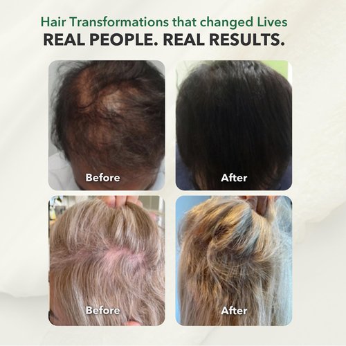 HairSmart Conditioner for Women & Men | Ayurvedic Deep Conditioner for Dry, Damaged Hair | Volumizing Hair Products | Hair Growth Accelerator, 100ml