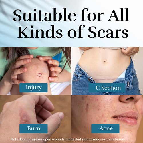 Advanced Scar Cream, Scar Reduction Treatment for Improves Skin Texture & Helps Remove Acne, Stretch Marks, Surgery, C Section, Burn, Keloid & Hypertrophic Scars 1.76 Oz (50g)