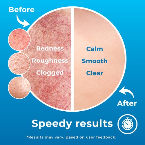 PatchRx Hypochlorous Acid Spray (8oz, 2 packs), HOCL Facial Cleanser Acne Spray for Face, Body, Eczema, Pimples, Breakouts & Overall Skin Recovery (Reduces Redness)