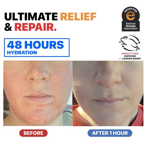 Dr. Arsy Eczema Cream for Adults & Kids – Hypoallergenic Barrier Repair Moisturizer, Clinically Proven (3 Studies), Fragrance-Free, Dermatologist Tested, Face & Body Hydration, NEA Accepted, USA Made