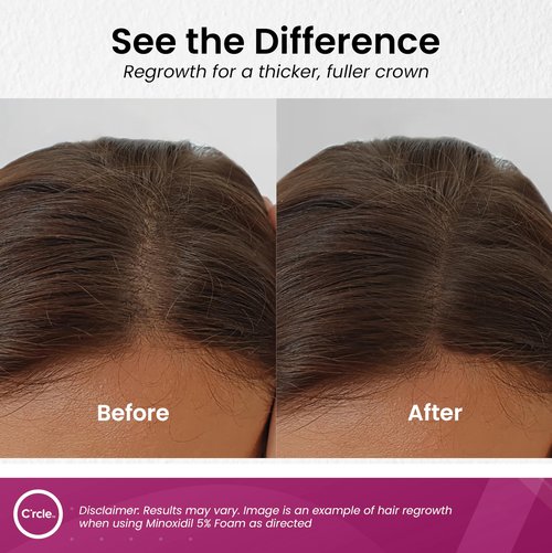 Minoxidil for Women 5% Foam - Helps Restore Top of Scalp Hair Loss and Support Hair Growth for Women, Regrowth with Unscented Topical Treatment for Thinning Hair (5% Foam 4-Month Supply)